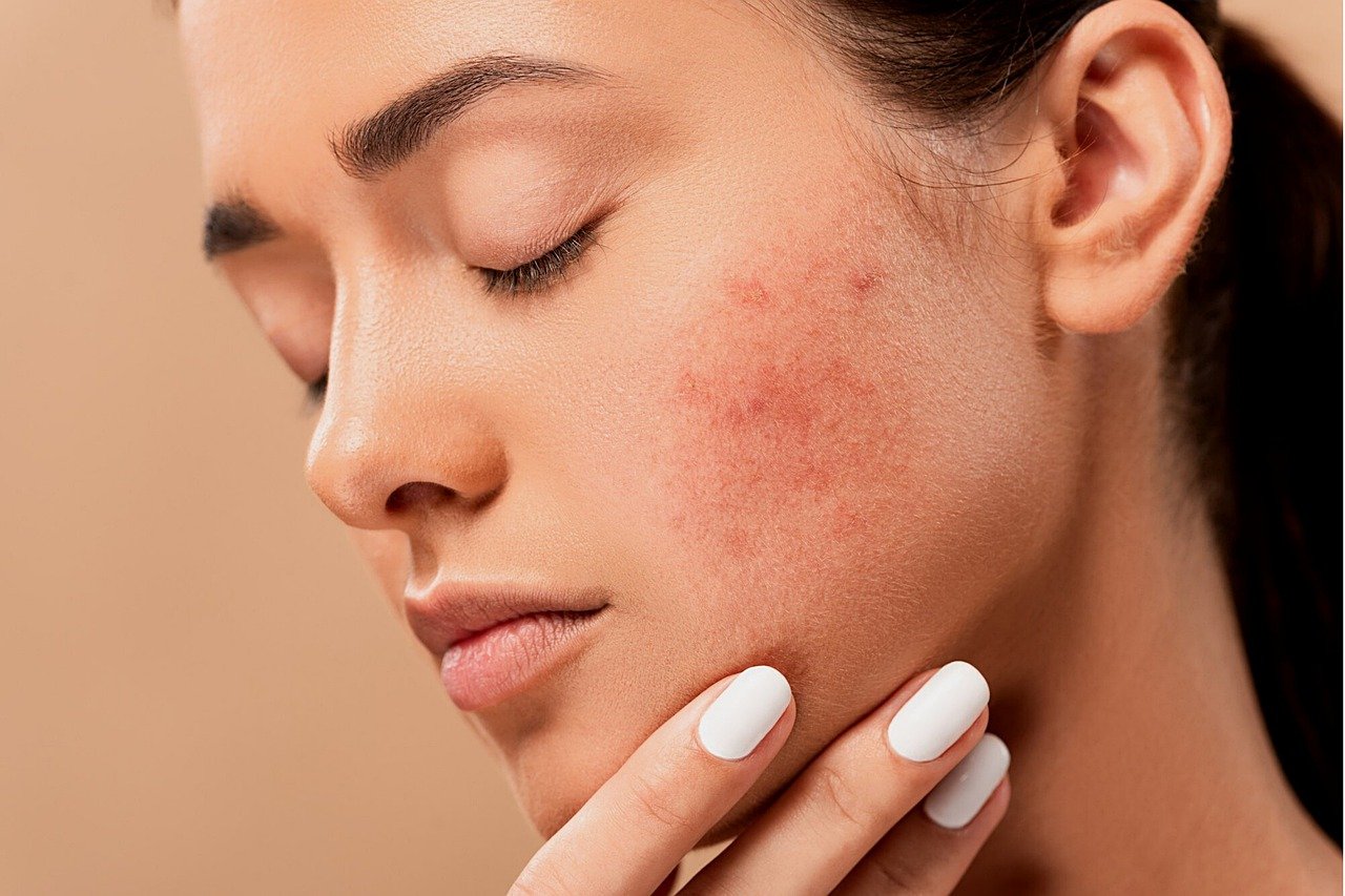 How to choose the right type of acne treatment
