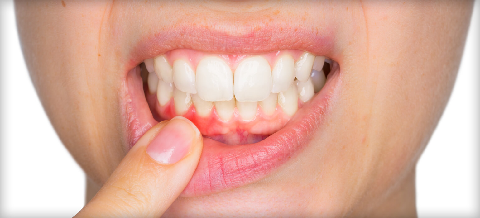 Periodontal Disease: The Hidden Gum Condition Needing More Publicity
